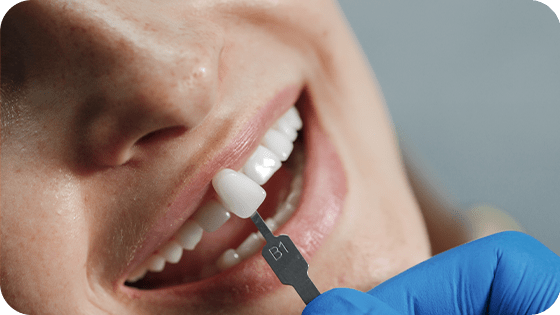 Seus dentes com um visual renovado e muito mais resistentes, com as soluções da São Lucas Odontologia!